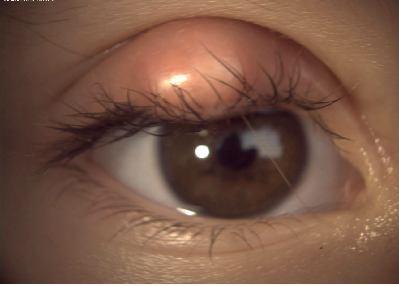 Chalazion qui ne part pas solutions efficaces CARE Montréal